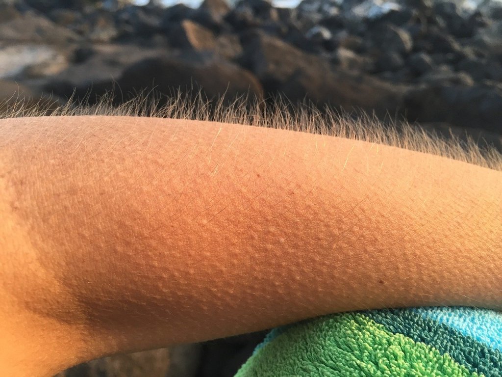 piel-gallina-calor-frio