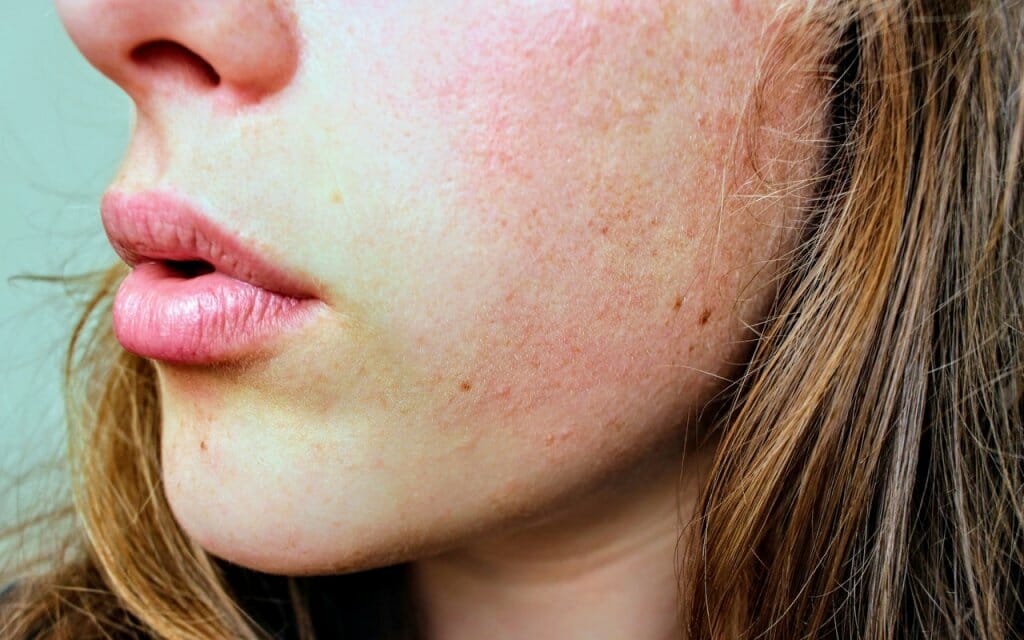 piel sensible rojeces alergia