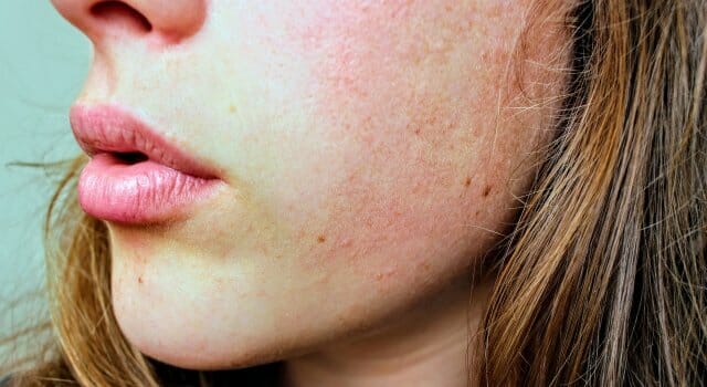 piel sensible rojeces alergia