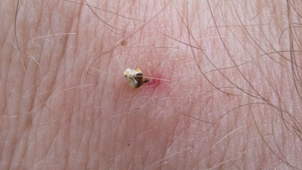 picadura abeja avispa aguijón picor dolor insectos