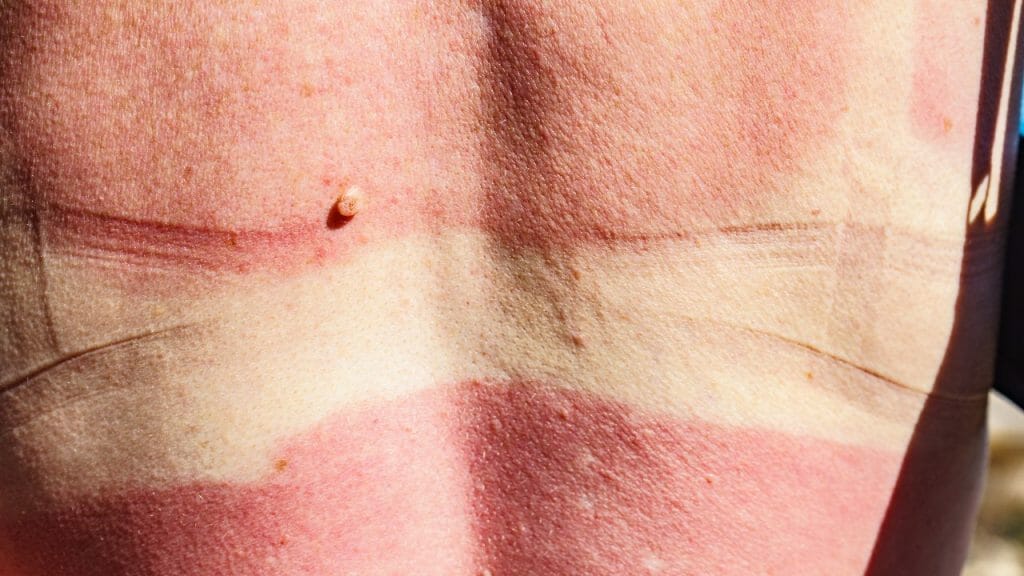 quemadura solar enrojecimiento de la piel factor de protección solar FPS SPF