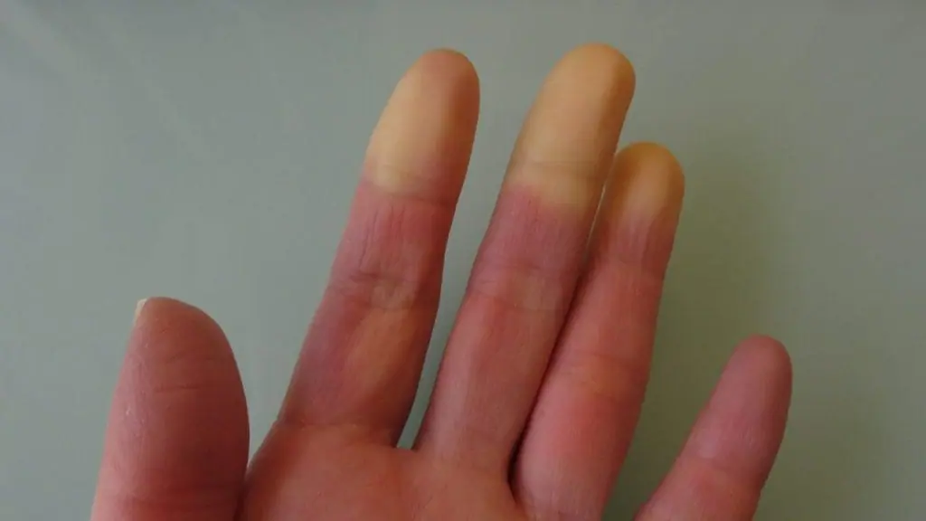Síndrome de Raynaud dedos manos frío circulación sangre color