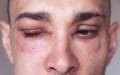 angioedema alrededor de los ojos causado por una reacción alérgica a agentes como picaduras de insectos, alimentos o medicamentos