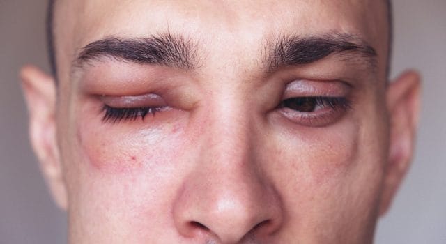 angioedema alrededor de los ojos causado por una reacción alérgica a agentes como picaduras de insectos, alimentos o medicamentos