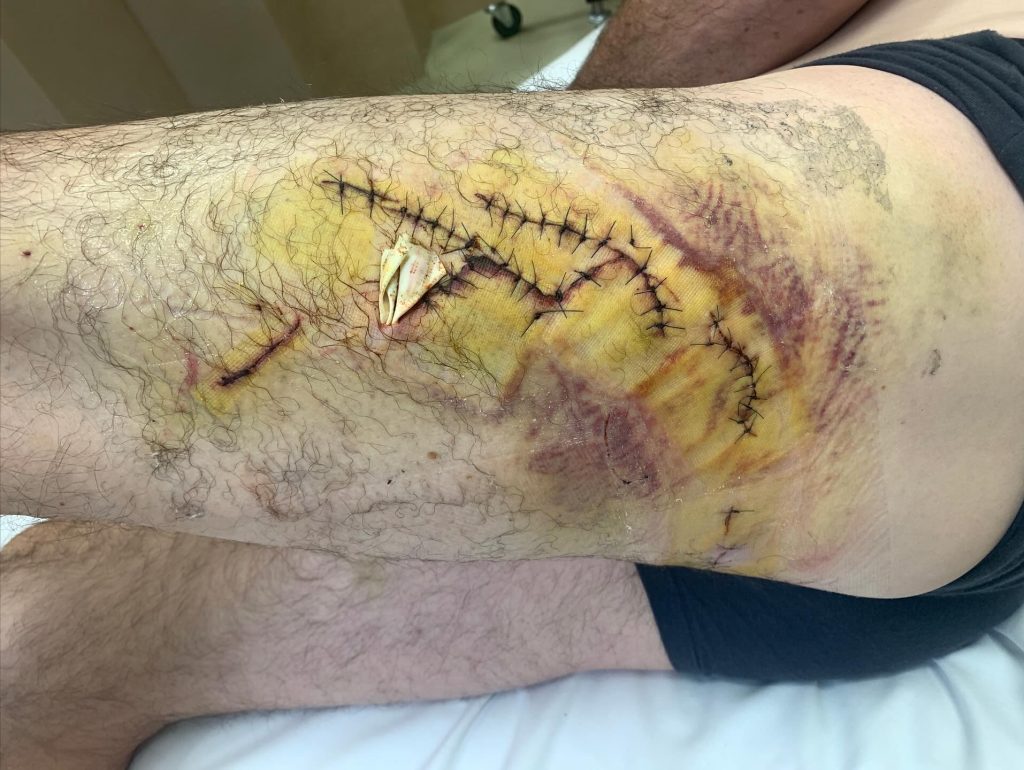 Un surfista australiano logró sobrevivir al ataque de un tiburón blanco en las costas de Australia gracias a la intervención inesperada de una familia de focas.