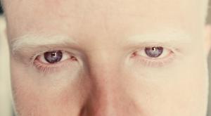 Albinos: la luz y el sol como enemigos
